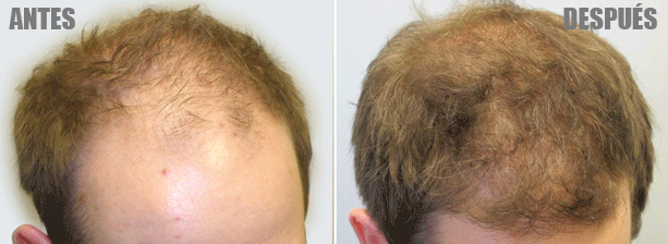 finasteride-minoxidil- 1 año