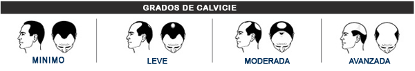 grado-calvicie